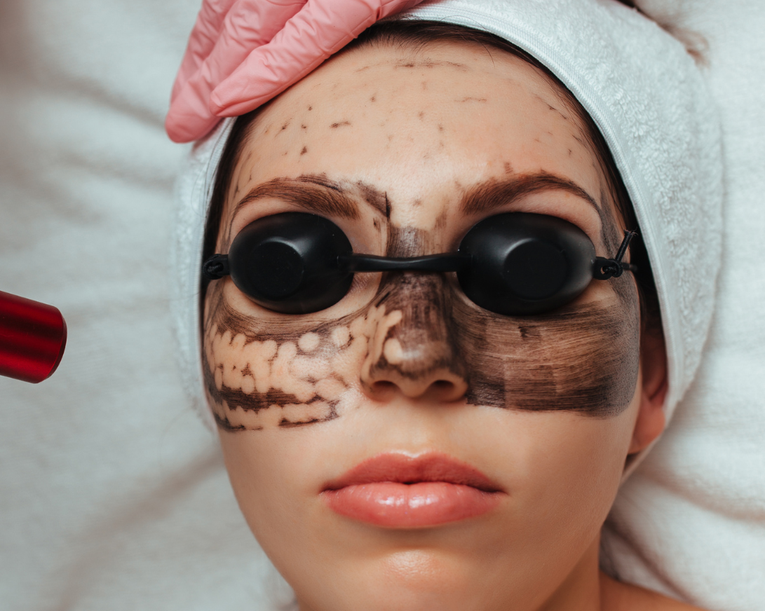 carbon laser peel brooklyn nyc - aesthetic allure