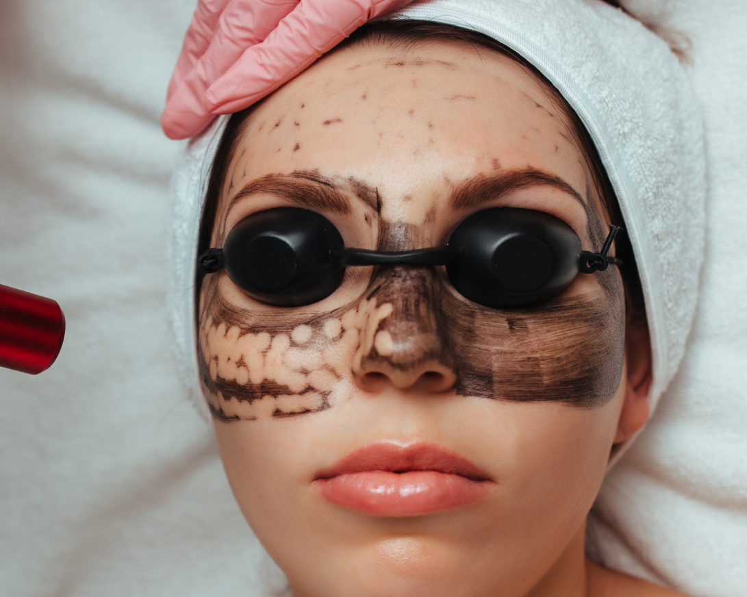 carbon laser peel brooklyn nyc - aesthetic allure 