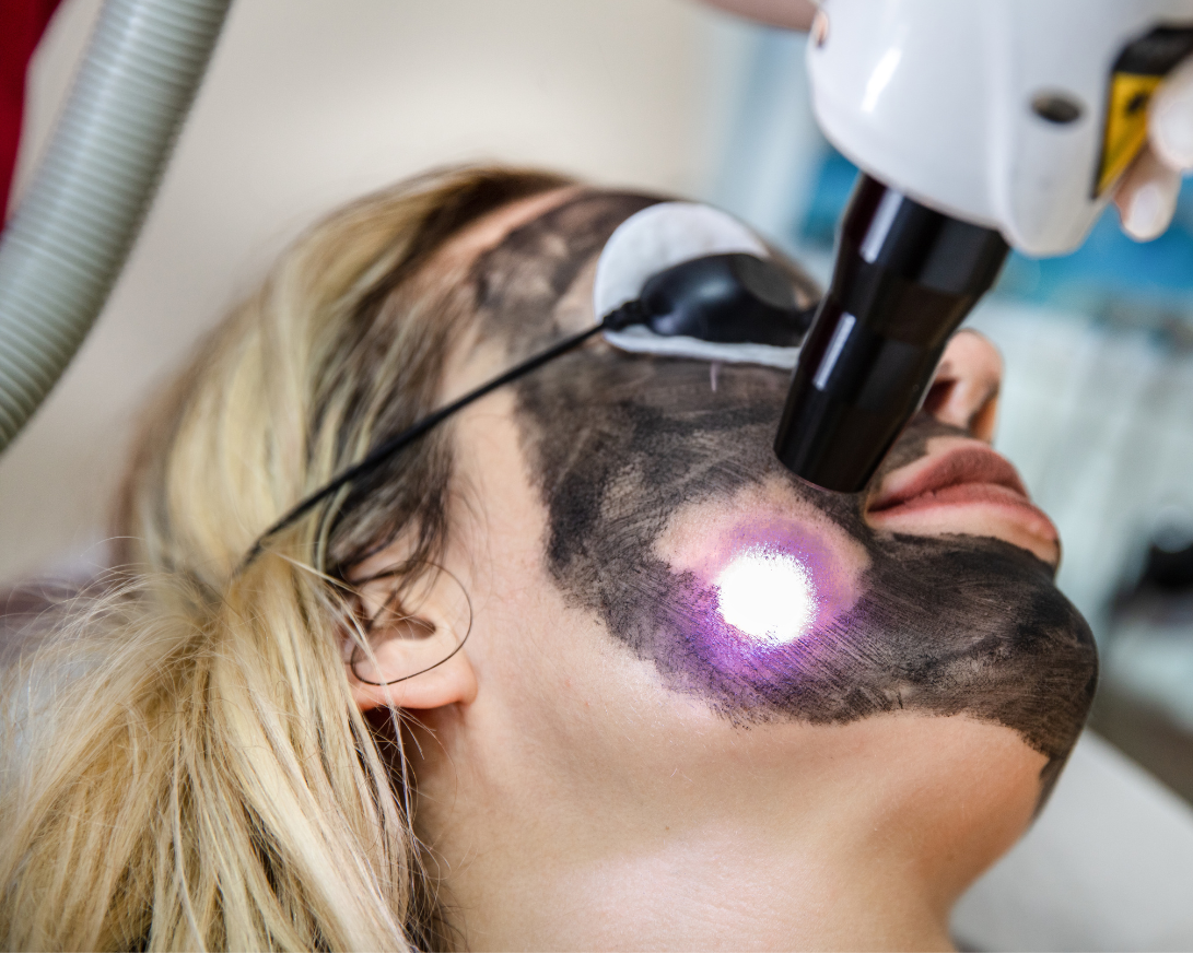 carbon laser peel nyc - aesthetic allure