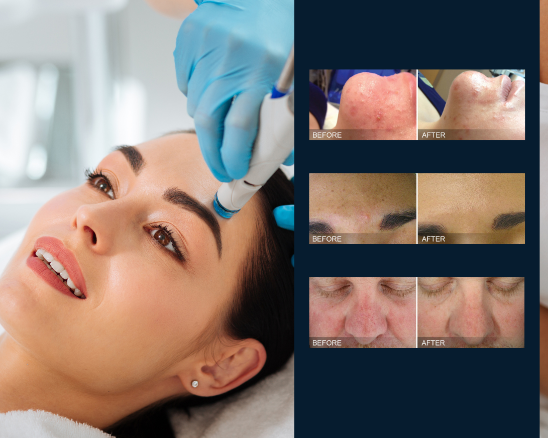 hydrafacial treatment before and after - Aesthetic Allure
