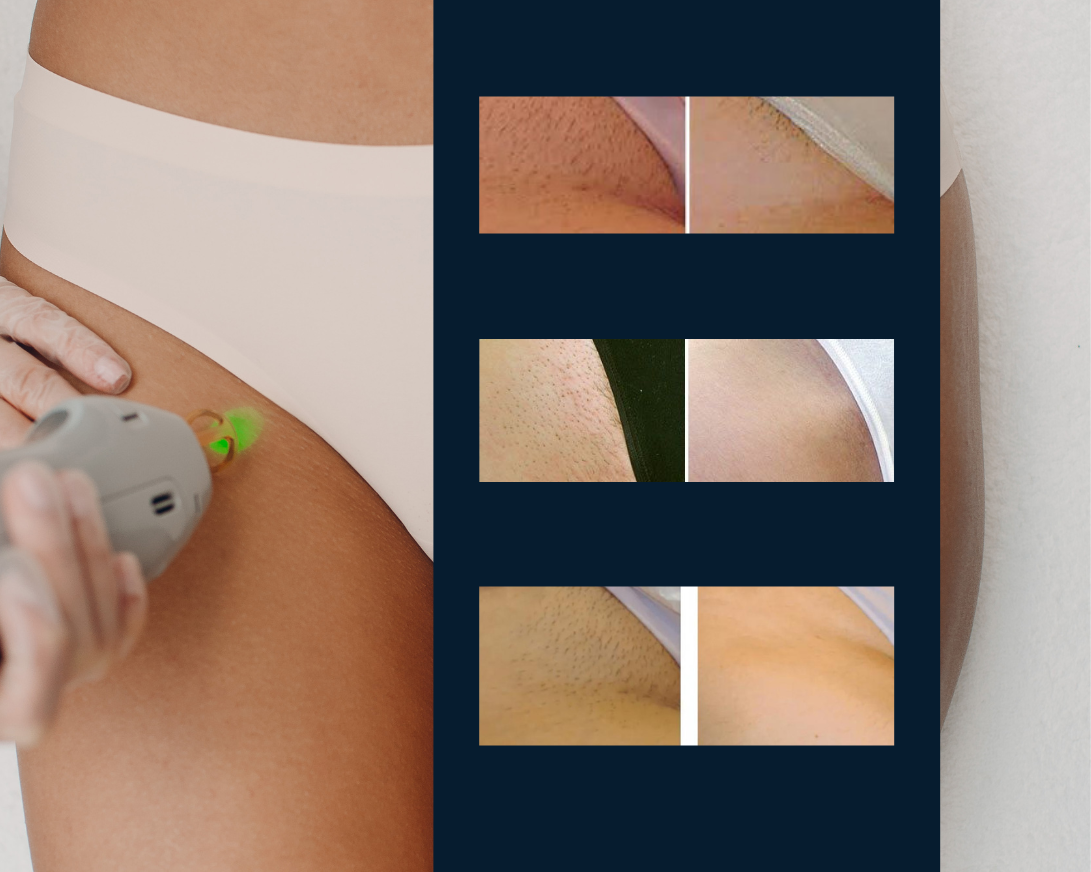 Brazilian Bikini Laser Hair Removal - Aesthetic Allure Brooklyn NYC