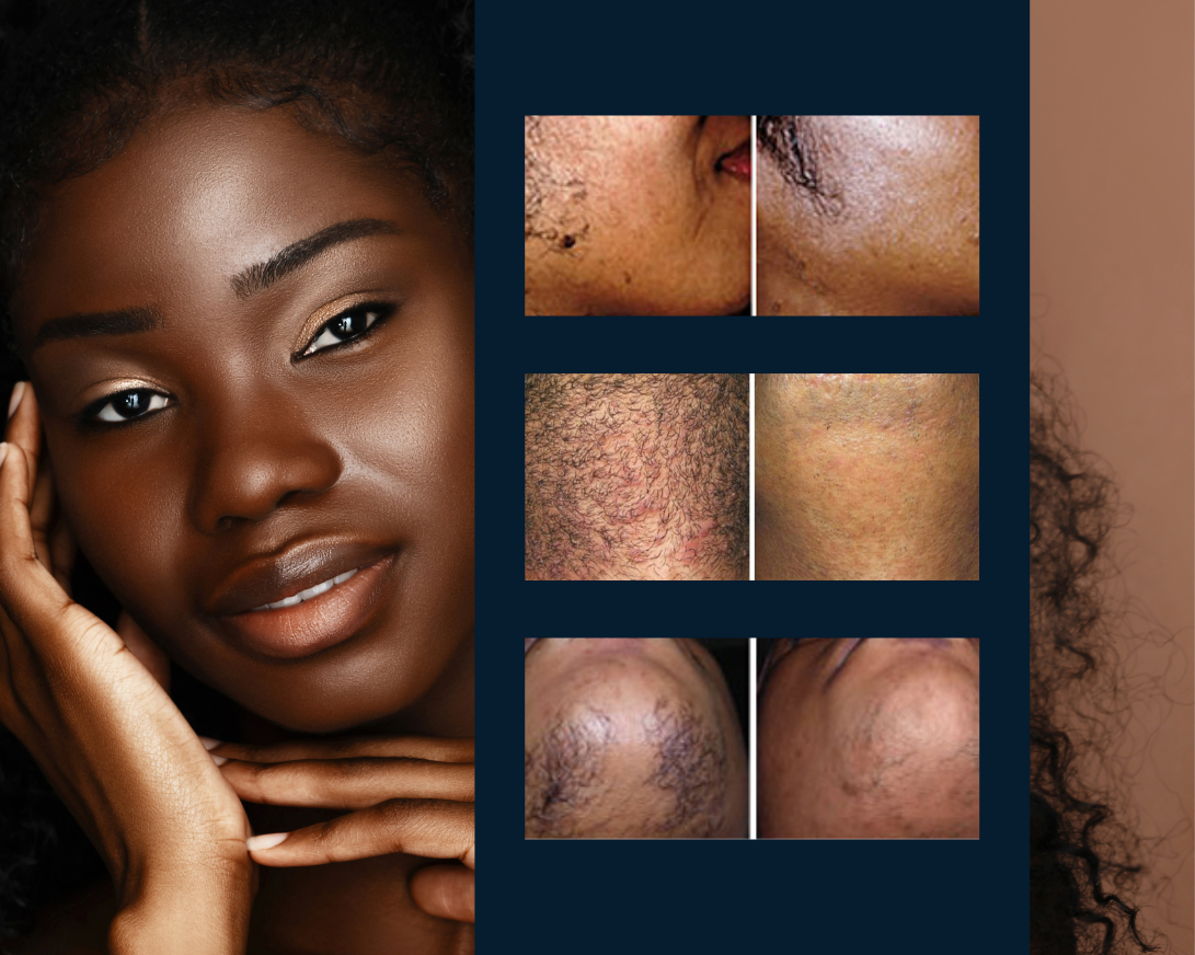 ingrown hair removal laser treatment for dark skin, full face laser hair removal dark skin