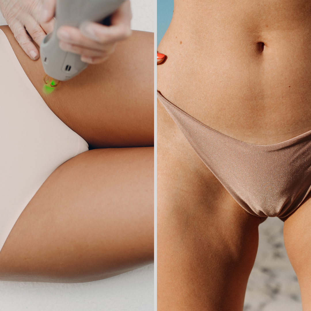 Bikini Line Laser