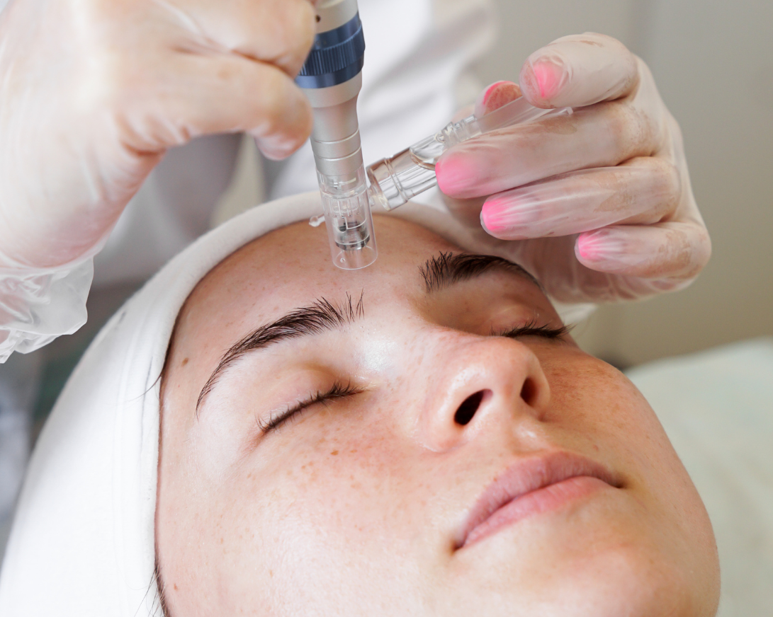 Microneedling Facial Treatment NYC - Aesthetic Allure Brooklyn