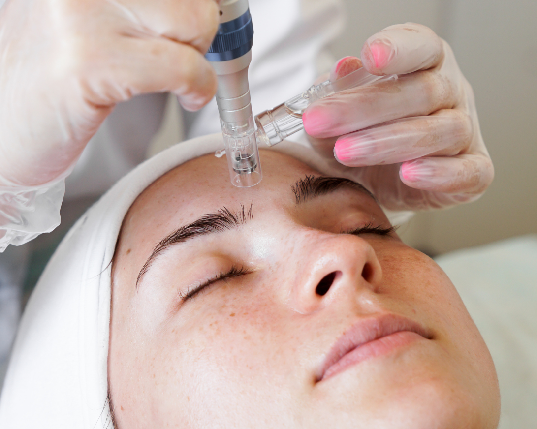 Microneedling Facial Treatment NYC - Aesthetic Allure Brooklyn 