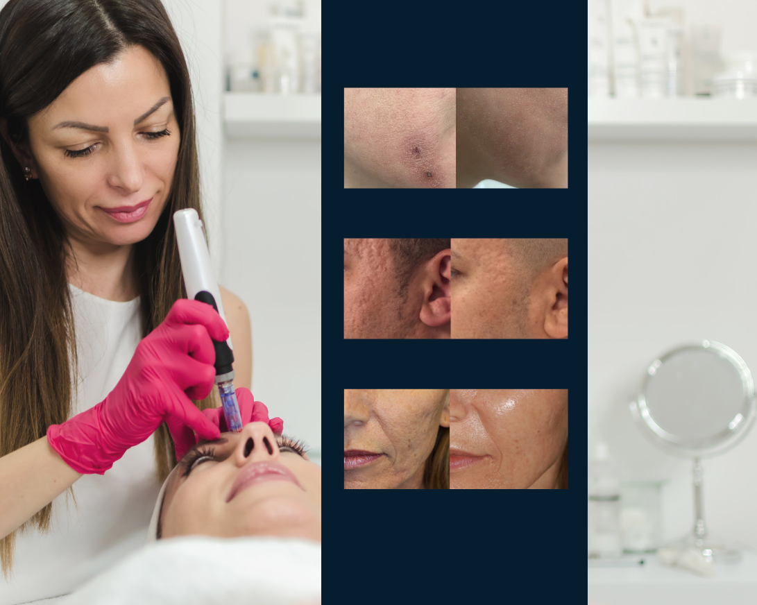 Microneedling Facial Treatment NYC - Aesthetic Allure before and after
