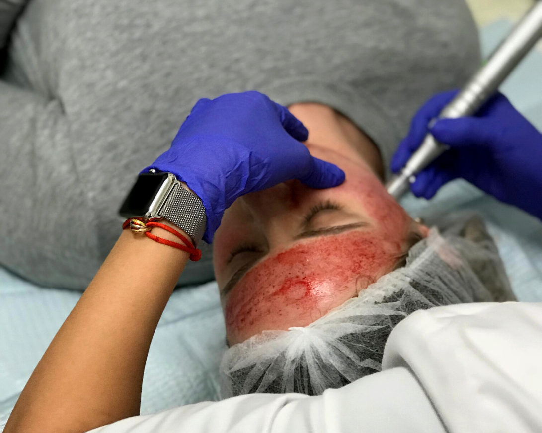 Microneedling with PRP, Platelet Rich Plasma, Vampire Facial NYC