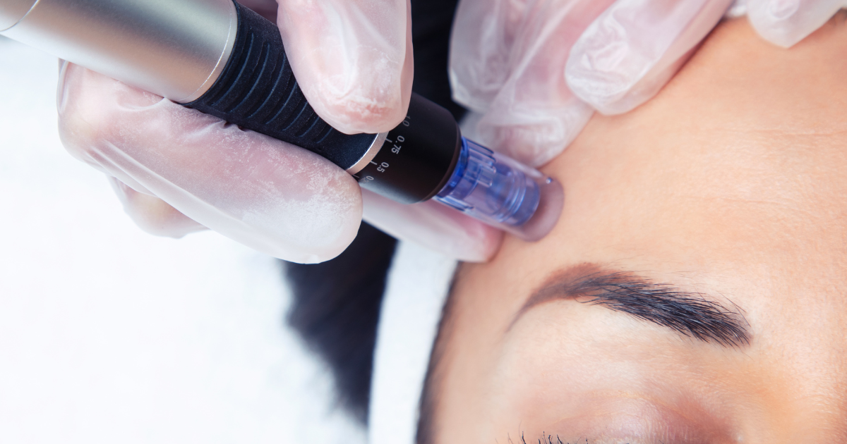 how often should you get microneedling. 