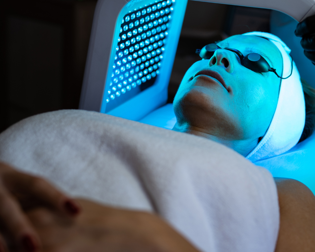 carbon laser peel treatment nyc - aesthetic allure