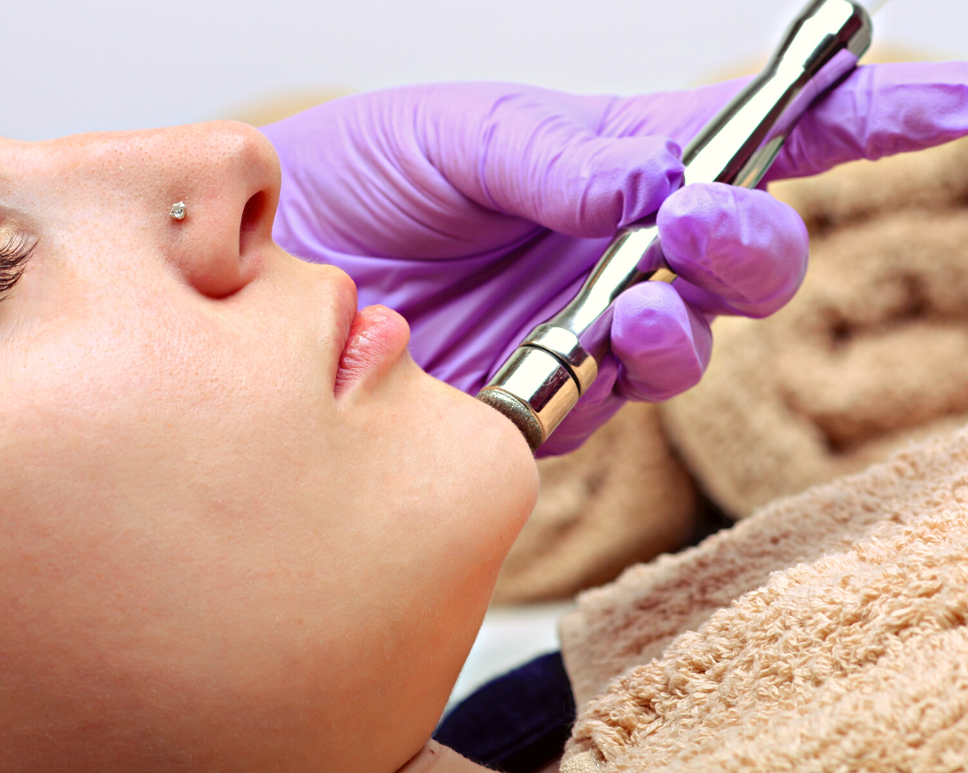 microdermabrasion facial treatment brooklyn, nyc - aesthetic allure 