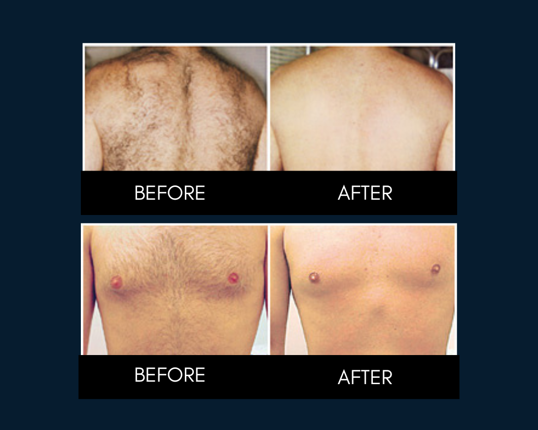 Chest, back, and arms laser hair removal treatment for men