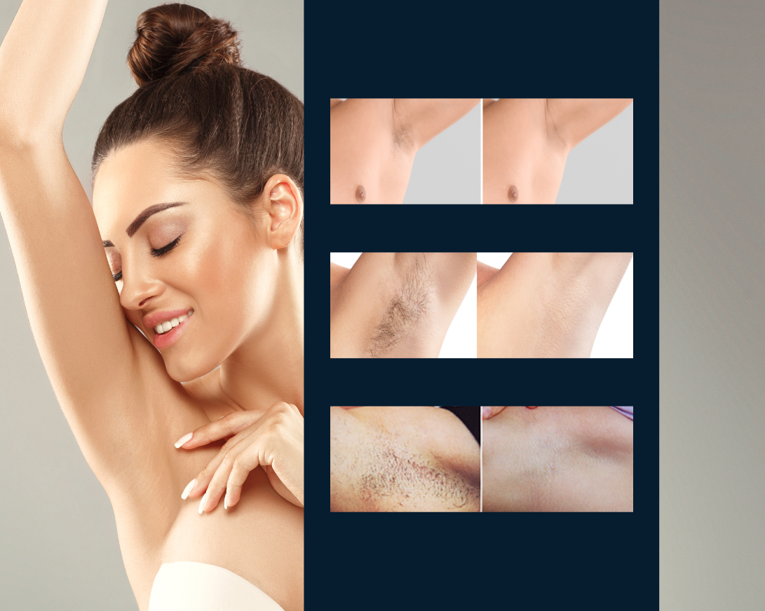 Laser Hair Removal Under Arms - Aesthetic Allure