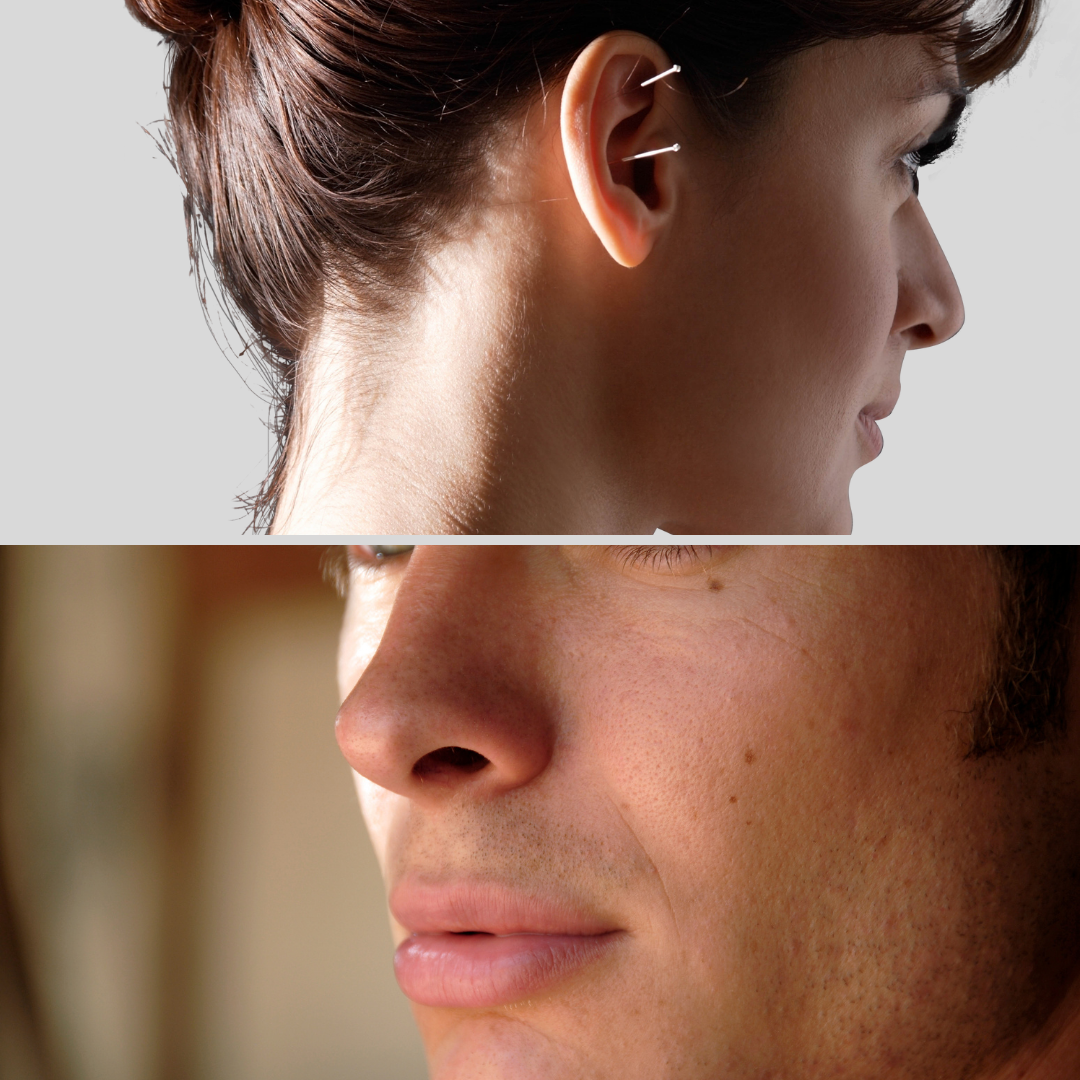 Sideburns Laser Hair Removal NYC Aesthetic Allure