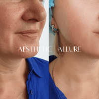 Before and after comparison of a woman's neck area with 'Aesthetic Allure' branding.