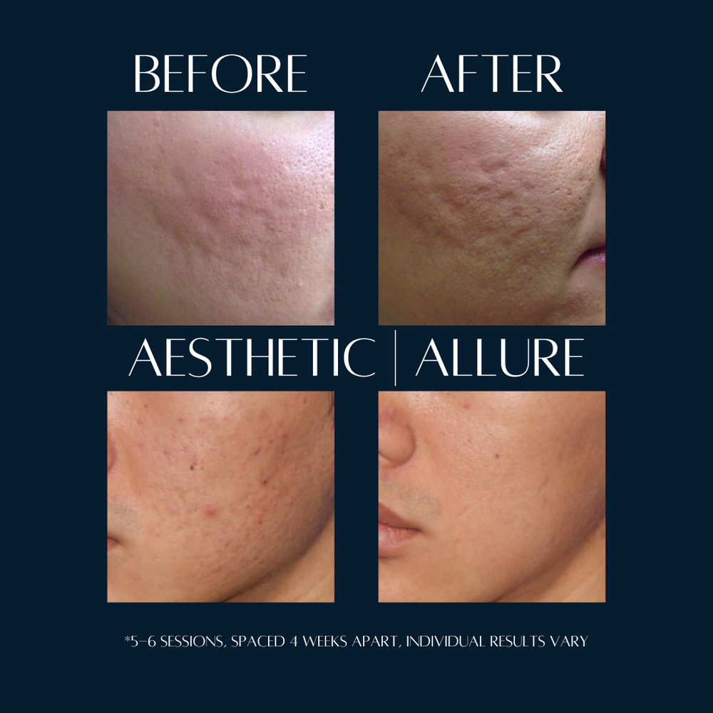 Microneedling Facial